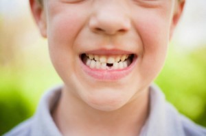 Affollamento dentale bambini