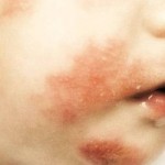 Dermatite seborroica infantile