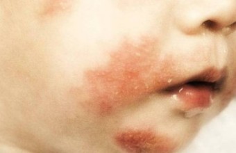 Dermatite seborroica infantile