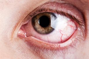 Sindrome dell'occhio secco