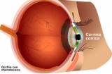 Cornea conica