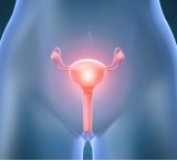 Tumore ovarico: bloccare le recidive per vivere meglio